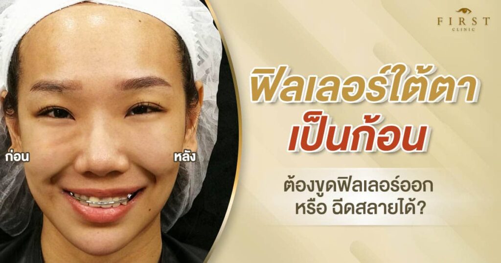 ฟิลเลอร์ใต้ตาเป็นก้อนแก้ยังไง