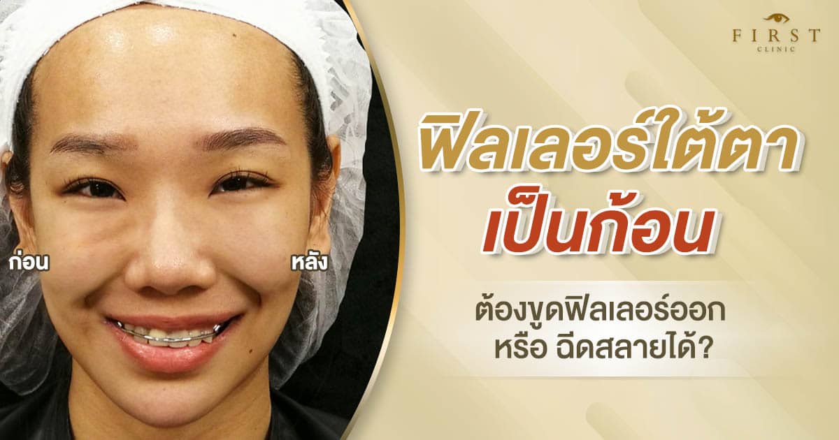 ฟิลเลอร์ใต้ตาเป็นก้อนแก้ยังไง