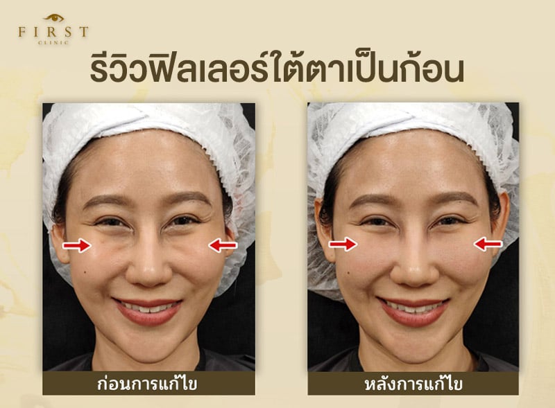 รีวิวฟิลเลอร์เป็นก้อน-คุณเบล